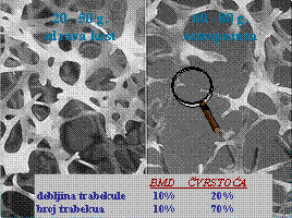 Zdrava i osteoporotična kost osteoporoaz 1
